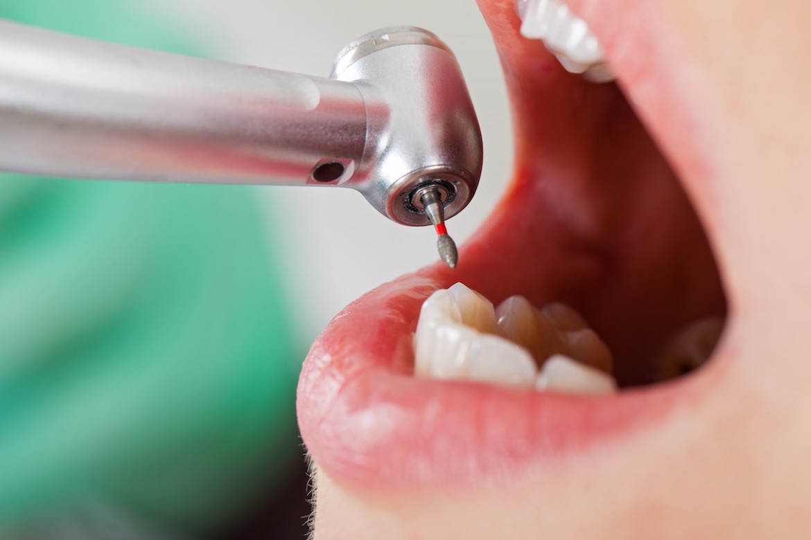Sbiancamento e pulizia denti Acilia Dr. Catinari
